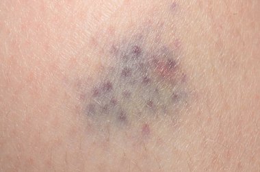 Bebek derisinde mor çürük. Yakın yaralanma. Doğal iyileşme.