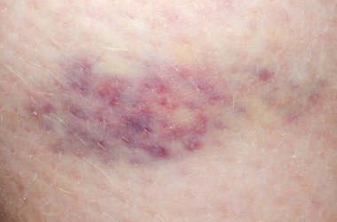 Çocuk bacağında morarma var. Cilt yaralanması var. Ağrı, mavi işaret sağlık konsepti.