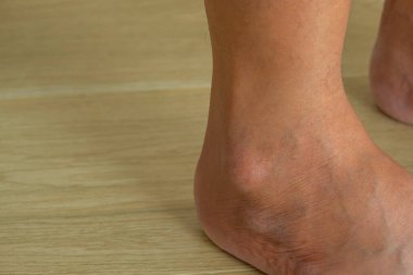 Close-up of swollen outer ankle with visible lump, highlighting possible ganglion cyst or inflammation. Ideal for medical, orthopedic, or wellness visuals.