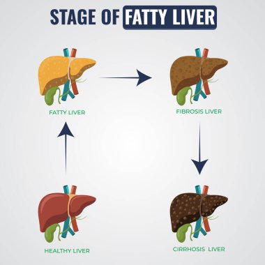 Yağlı karaciğer hastalığı, diyet ve yaşam tarzı değişiklikleriyle kontrol edilmezse ciddi karaciğer hasarına yol açabilecek yağ yataklarını içerir.