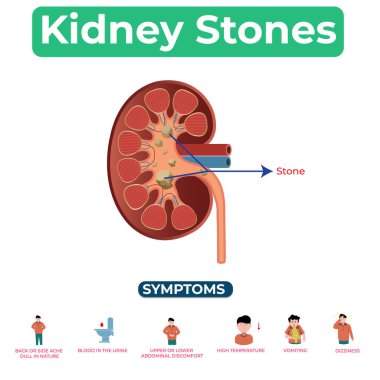 Böbrek taşları hakkında bilgi edinmek, bu ağrılı durumu etkili bir şekilde yönetmek ve böbrek sağlığını iyileştirmek için belirtilerin önlenmesine ve tedavi seçeneklerine yol açar