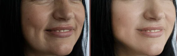 Γυναίκα Πρόσωπο Ρυτίδες Πριν Και Μετά Από Διπλή Θεραπεία Πηγούνι — Φωτογραφία Αρχείου