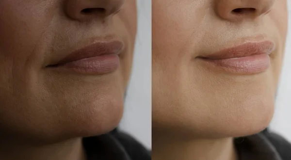 Wanita Wajah Keriput Sebelum Dan Setelah Perawatan Dagu Ganda — Stok Foto