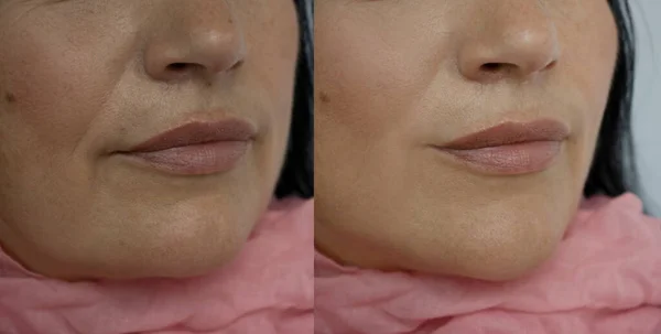 Woman face wrinkles before and after double chin treatment