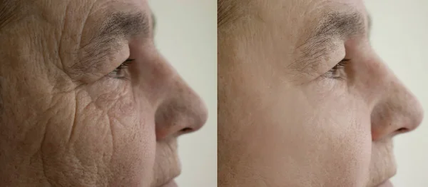 Elderly woman face wrinkles before and after treatment