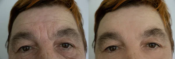 Elderly woman face wrinkles before and after treatment