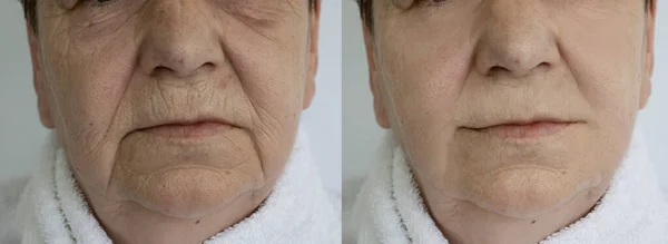 治療前と治療後の女性の顔のしわ — ストック写真