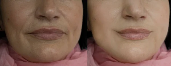 Arrugas Faciales Antes Después Del Tratamiento — Foto de Stock