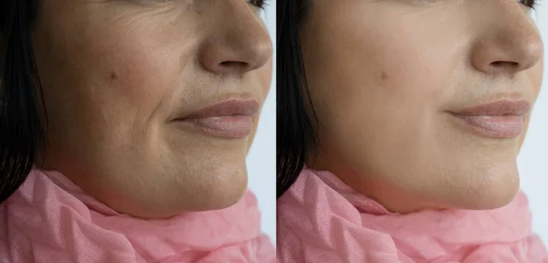 Arrugas Faciales Antes Después Del Tratamiento —  Fotos de Stock