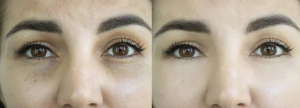 Mujer Ojos Arrugan Antes Después Del Tratamiento —  Fotos de Stock