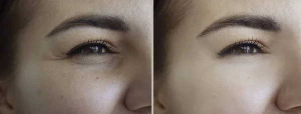 Γυναίκα Ρυτίδων Μάτια Πριν Και Μετά Θεραπεία — Φωτογραφία Αρχείου