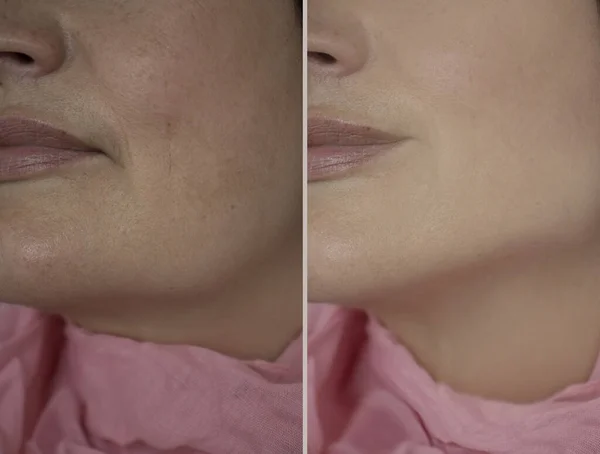 Arruga Cara Mujer Antes Después Del Tratamiento — Foto de Stock