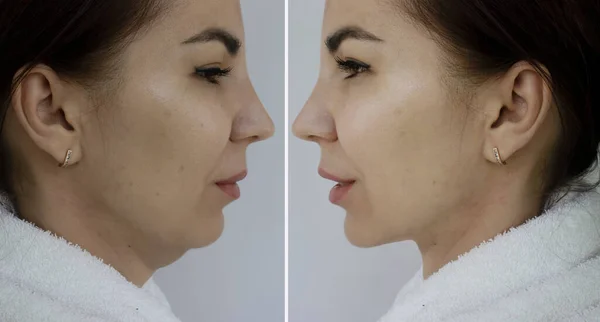 治療前と治療後の女性の二重あご ロイヤリティフリーのストック画像