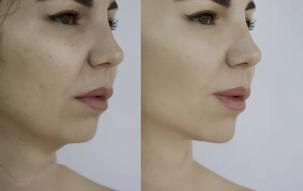 治療前と治療後の女性の顔のしわ ロイヤリティフリーのストック写真