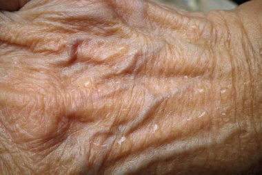 Kıdemli kadının sağ elinin arkasındaki kan lekeli deri dokusu, Makro kareyi kapat, seçici odak, Asyalı vücut parçası, sağlık sigortası konsepti
