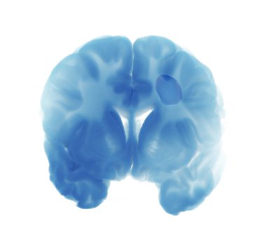 İnsan beyninin koronal görüntüsü, maviyle işaretlenmiş, iskemik felcin etkilerini açıkça gösteriyor. Tıp eğitimi, bilimsel araştırma ve sağlık sunumları için mükemmel..