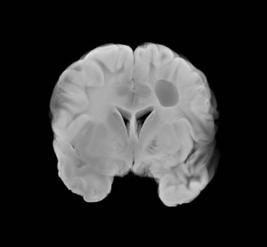 İnsan beyninin koronal görüntüsü, açıkça iskemik felci gösteriyor. Tıbbi araştırmalarda, eğitim materyallerinde ve sağlık sunumlarında kullanım için ideal