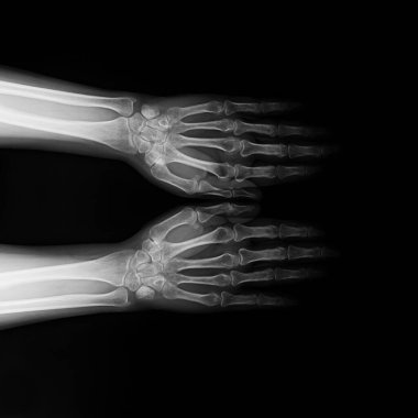 Symmetrical X-ray radiograph of two human wrists and hands with forearms on black background. Medical image showing bones of the carpus, metacarpals, phalanges, radius, and ulna