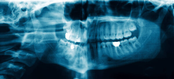 Panoramic dental X-ray radiograph image showing the entire mouth and jaw structure. Human skull with teeth, bone, and a filling for dentistry concept