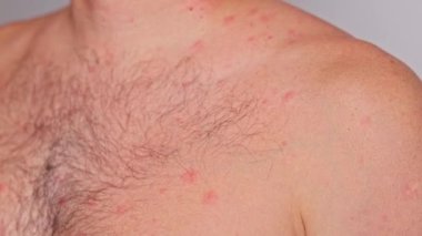 Sivilceli bir adam, kırmızı noktalar, deri hastalığı. Varicella ya da Herpes Zoster konsepti