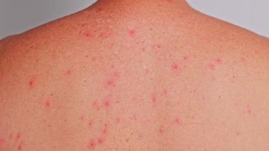 Adamın sırtında sivilceler, kırmızı lekeler, deri hastalığı var. Varicella ya da Herpes Zoster konsepti