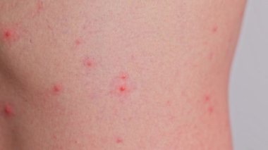 Sivilceli bir adam, kırmızı noktalar, deri hastalığı. Varicella ya da Herpes Zoster konsepti