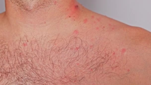 Pria Dengan Jerawat Bintik Merah Penyakit Kulit Varicella Atau Herpes — Stok Video