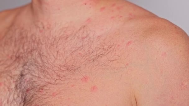 有粉刺 皮肤病的男人水痘或疱疹的概念 — 图库视频影像