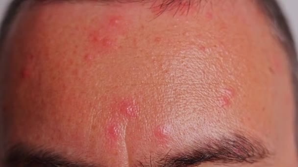 男人的额头有粉刺红斑皮肤病水痘或疱疹的概念 — 图库视频影像