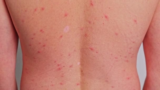 男人的背有粉刺红斑皮肤病水痘或疱疹的概念 — 图库视频影像