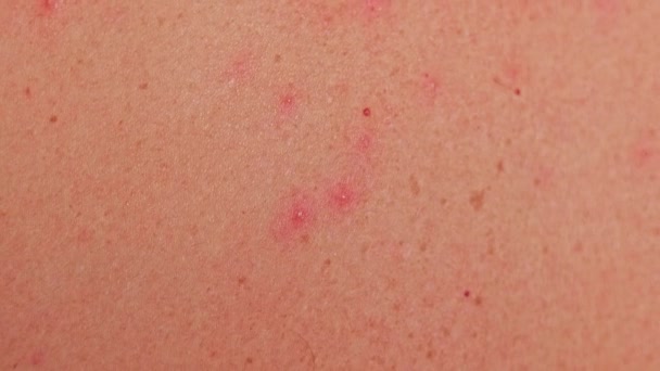 Der Rücken Des Menschen Mit Akne Roten Flecken Hautkrankheiten Varizellen — Stockvideo