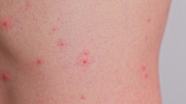 Homem Com Acne Manchas Vermelhas Doença Pele Conceito Varicela Herpes — Vídeo de Stock