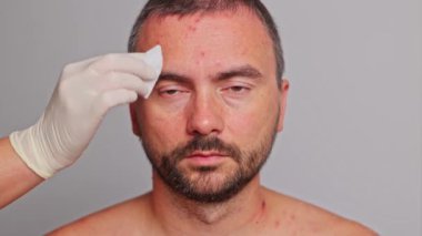Adamın alnında sivilce, kırmızı noktalar, deri hastalığı. Varicella ya da Herpes Zoster konsepti