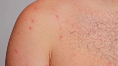 Adamın omzu sivilceli, kırmızı noktalı, deri hastalıklı. Varicella ya da Herpes Zoster konsepti