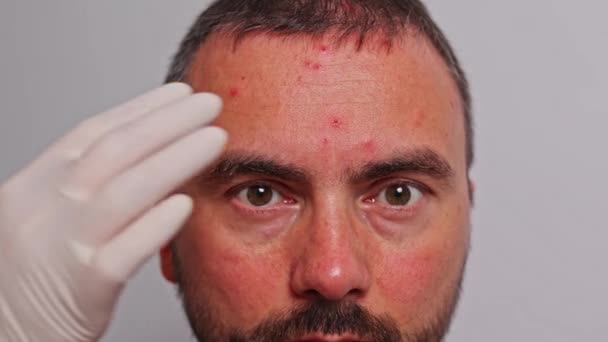 Männliche Stirn Mit Akne Roten Flecken Hauterkrankungen Varizellen Oder Herpes — Stockvideo