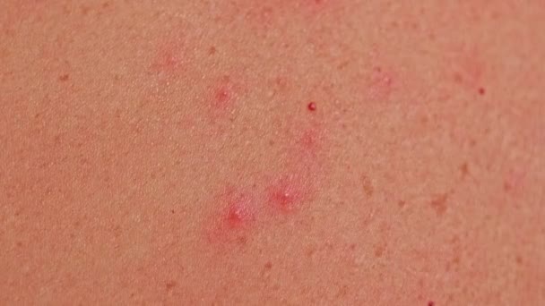 にきび 赤い斑点 皮膚病を持つ男の背中 VaricellaまたはHerpes Zosterの概念 — ストック動画