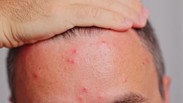 Man Forehead Acne Red Spots Skin Disease Varicella Herpes Zoster — Stock Video