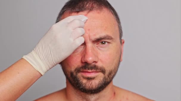 にきび 赤い斑点 皮膚病を持つ男の額 VaricellaまたはHerpes Zosterの概念 — ストック動画