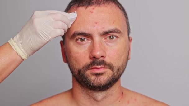 Testa Homem Com Acne Manchas Vermelhas Doenças Pele Conceito Varicela — Vídeo de Stock