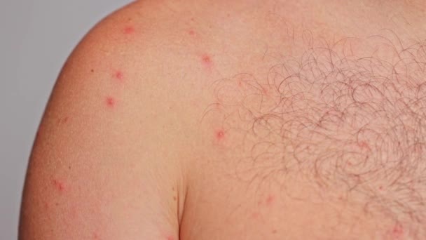 男人的肩膀有粉刺红斑皮肤病水痘或疱疹的概念 — 图库视频影像
