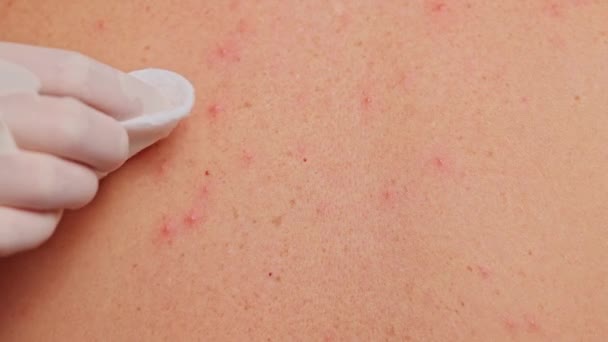 Der Rücken Des Menschen Mit Akne Roten Flecken Hautkrankheiten Varizellen — Stockvideo
