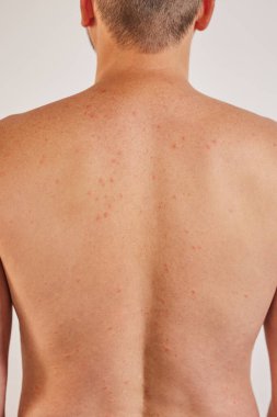 Adamın sırtında sivilceler, kırmızı lekeler, deri hastalığı var. Varicella ya da Herpes Zoster konsepti