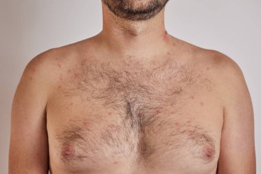 Sivilceli bir adam, kırmızı noktalar, deri hastalığı. Varicella ya da Herpes Zoster konsepti