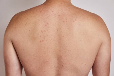 Adamın sırtında sivilceler, kırmızı lekeler, deri hastalığı var. Varicella ya da Herpes Zoster konsepti