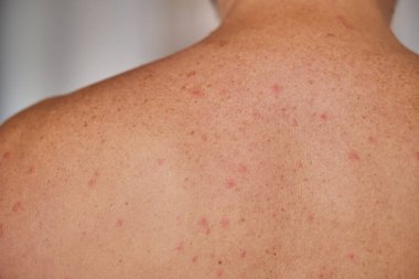 Adamın sırtında sivilceler, kırmızı lekeler, deri hastalığı var. Varicella ya da Herpes Zoster konsepti