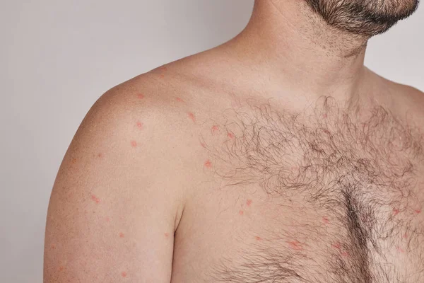 Shoulder Chest Man Acne Red Spots Skin Disease Varicella Herpes — Stock Photo, Image