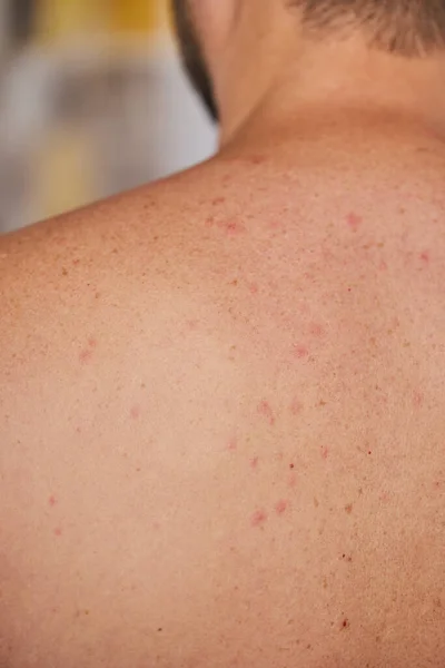 Man Back Acne Red Spots Skin Disease Varicella Herpes Zoster — Stock Photo, Image