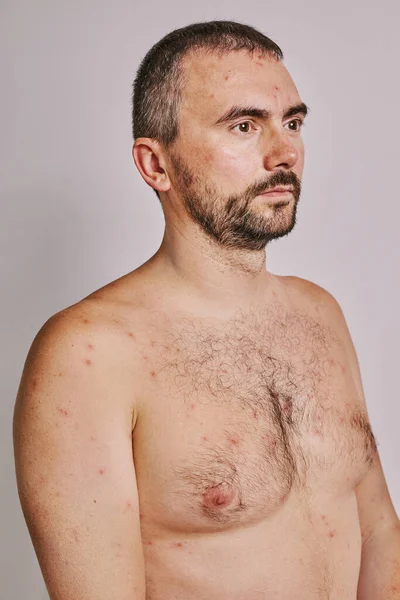 Muž Akné Červené Skvrny Kožní Onemocnění Koncept Varicella Nebo Herpes — Stock fotografie