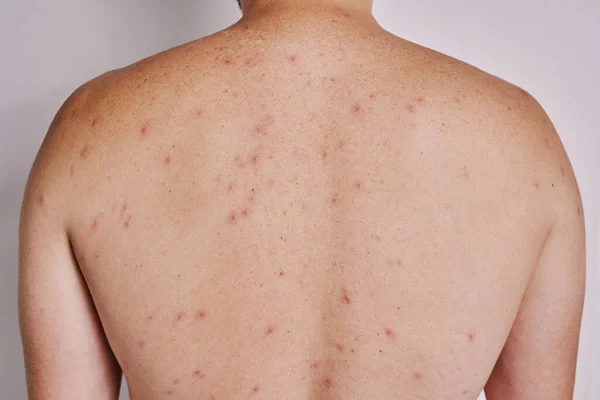 Adamın sırtında sivilceler, kırmızı lekeler, deri hastalığı var. Varicella ya da Herpes Zoster konsepti