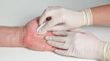 Tıbbi eldivenli kadın elleri, bir erkeğin elindeki sıcak yanığı antiseptikle tedavi eder. Avuçta yanmış deri.